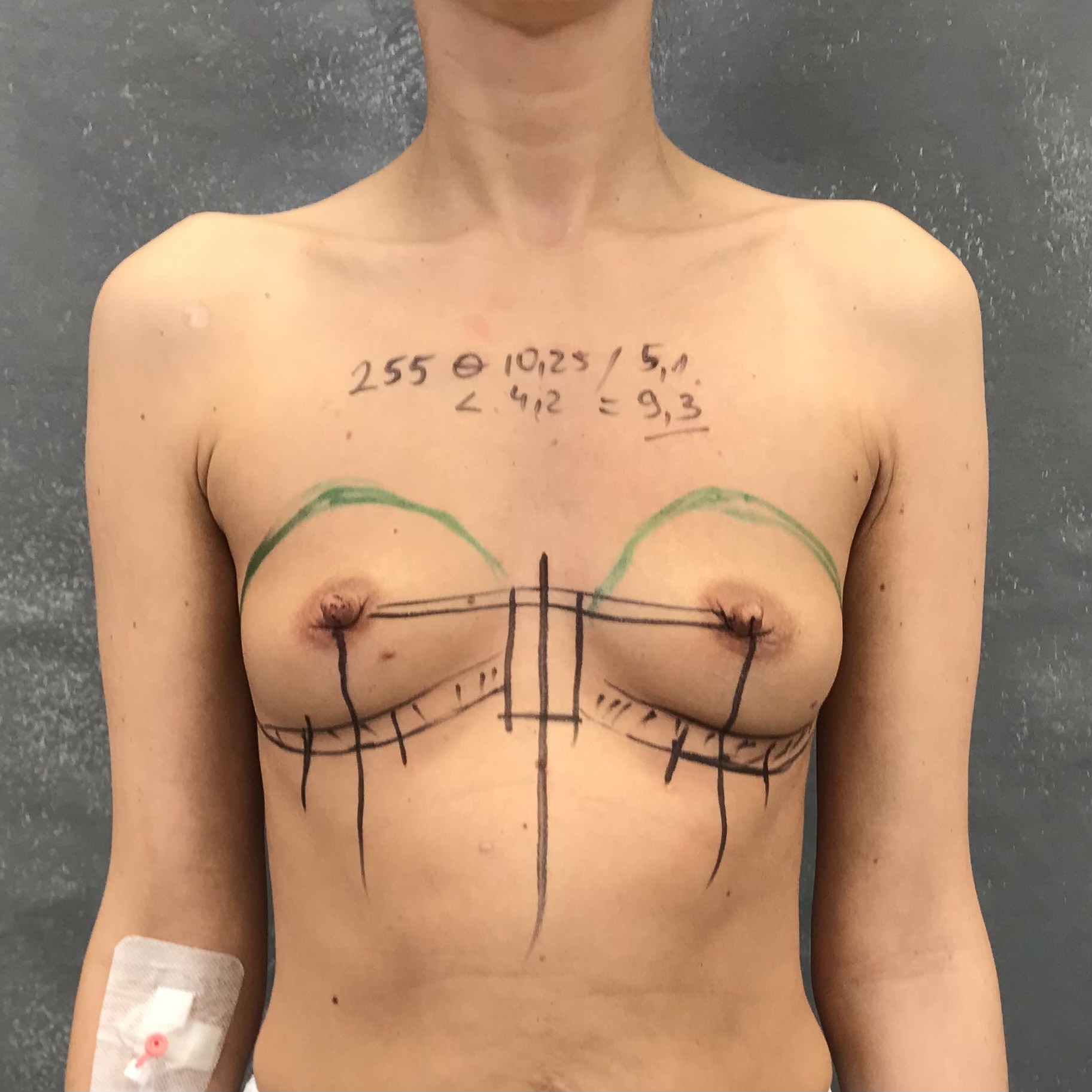 Powiększenie piersi — Przed