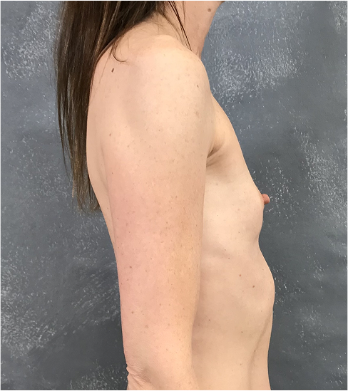 Powiększenie piersi — Przed