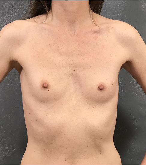 Powiększenie piersi — Przed