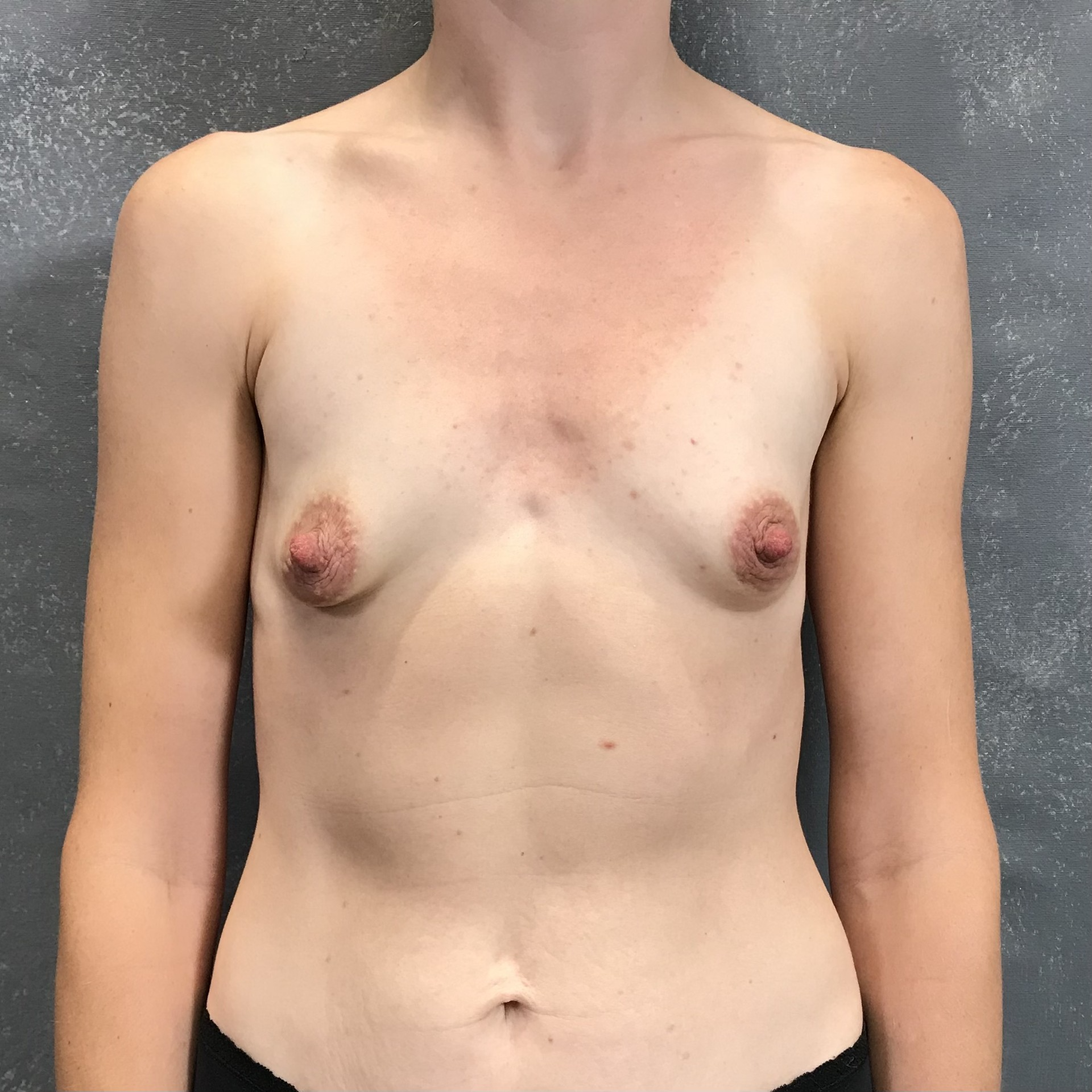 Powiększenie piersi — Przed