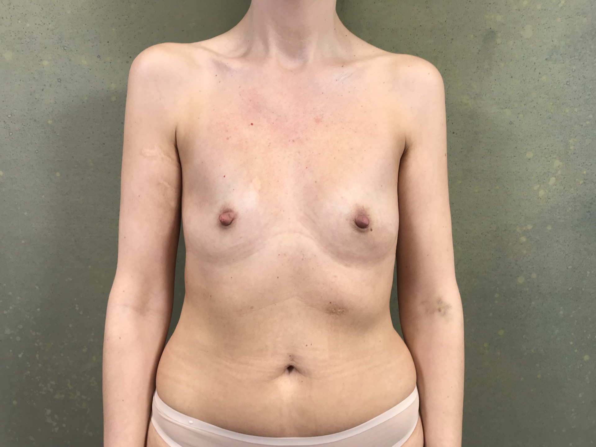 Powiększenie piersi — Przed