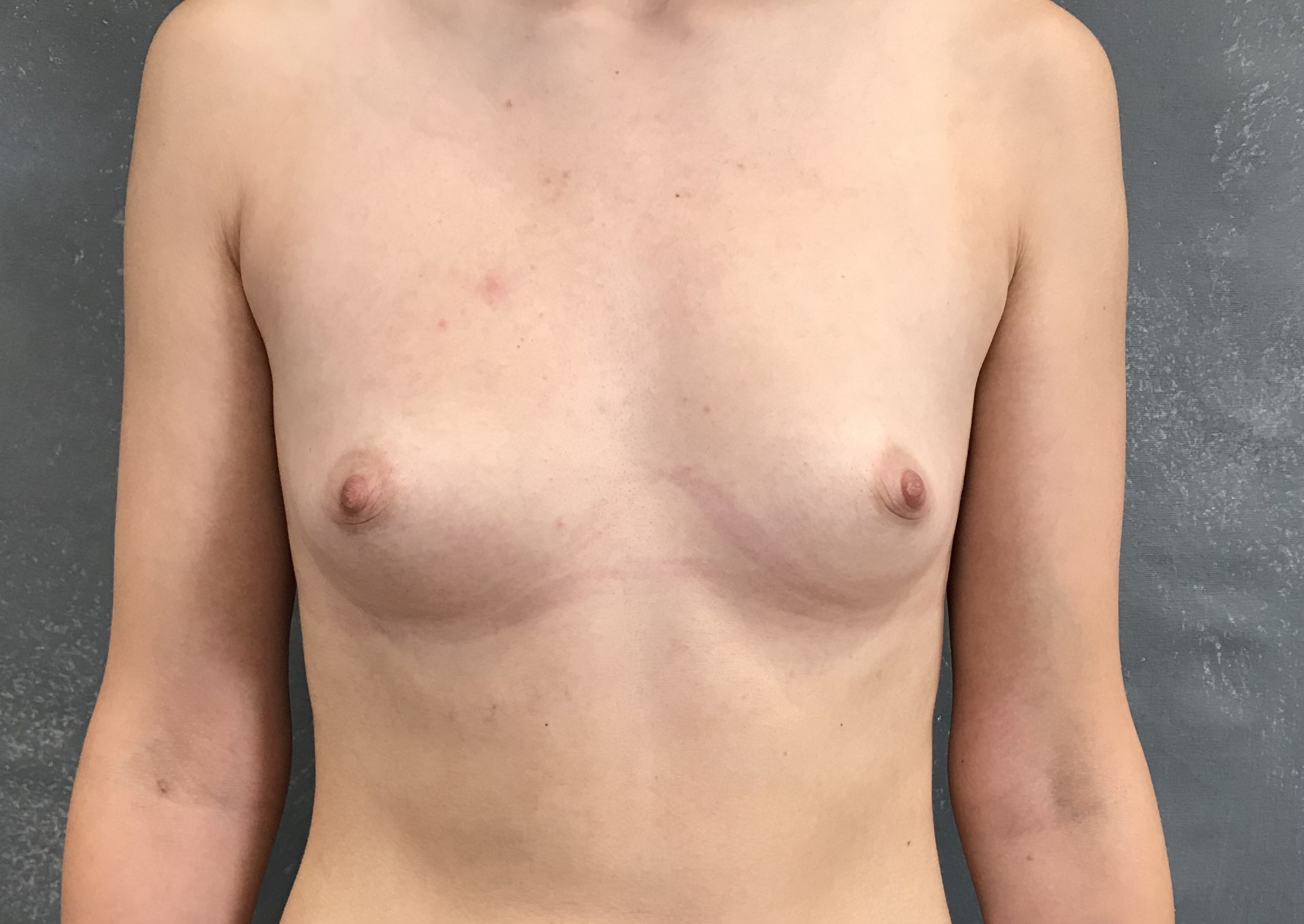 Powiększenie piersi — Przed